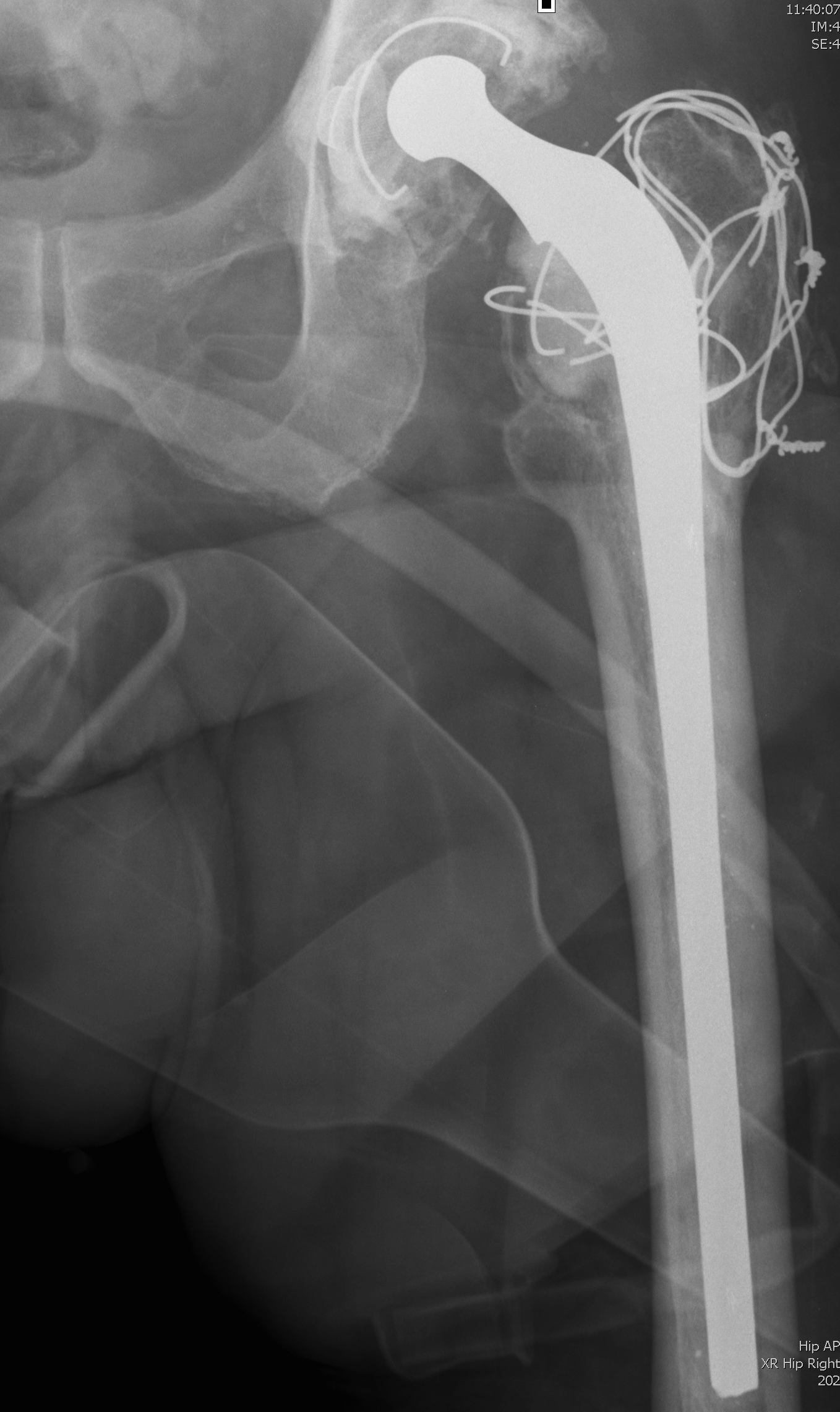 Revision Femur Long stem Cemented Component